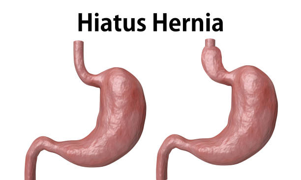 The hiatal hernia is the advancement of part of the stomach towards the esophagus, isolated over white background. stock photo