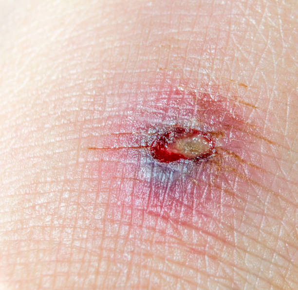 Best Open Wound Healing Process Stock Photos Pictures Royalty Free Best Open Wound Healing Process Stock Photos Pictures Royalty Free