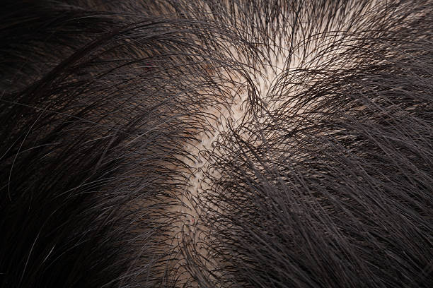 Thinning hair and scalp stock photo