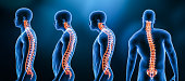 istock Three main curvatures of the spine disorders or deformities on male body: lordosis, kyphosis and scoliosis 3D rendering illustration. Human anatomy, back injury or disease, medical concepts. 1337099221