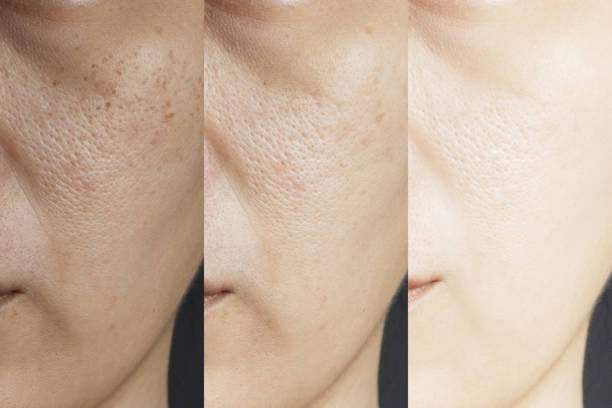 three pictures compared effect Before and After treatment. skin with problems of freckles , pore , dull skin and wrinkles before and after treatment to solve skin problem for better skin result stock photo