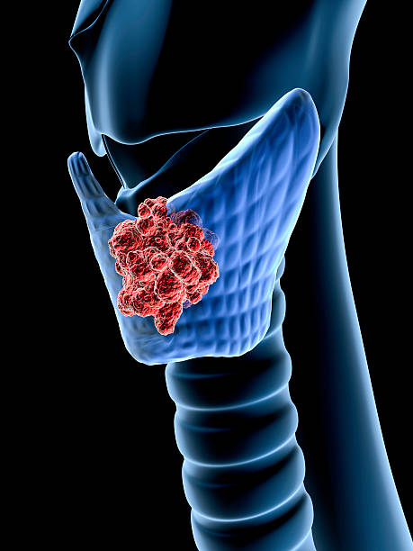 Thyroid cancer stock photo