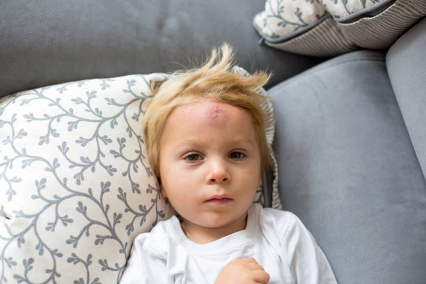 Toddler boy, lying on the couch with big bump on the forehead after falling from a swing stock photo