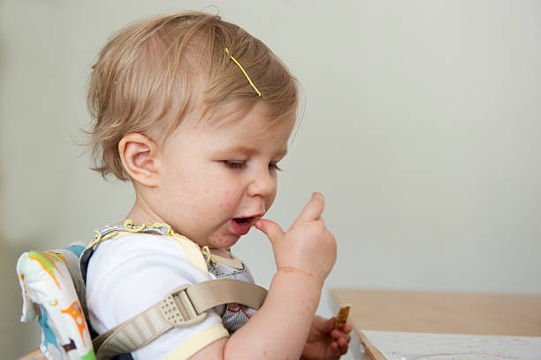 Toddler with hand , foot and mouth disease stock photo