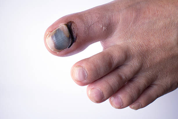 Toe Nail With Bruise Stock Photos, Pictures & Royalty-Free Images - iStock