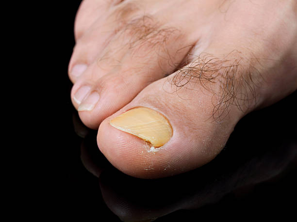 Broken Big Toe Stock Photos, Pictures & Royalty-Free Images - iStock
