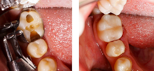 Tooth filling by dentist The aesthetic restoration of a lower molar tooth with composite resin. dental cavity stock pictures, royalty-free photos & images