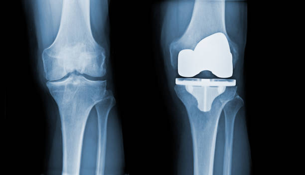 Total Knee Replacement X-ray - before and after stock photo