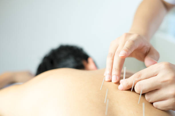 traditional acupuncture treatment  acupuncture stock pictures, royalty-free photos & images