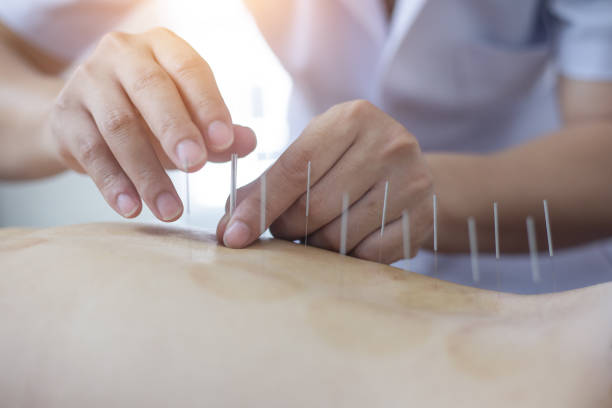Traditional Chinese Medicine Treatment - Acupuncture stock photo