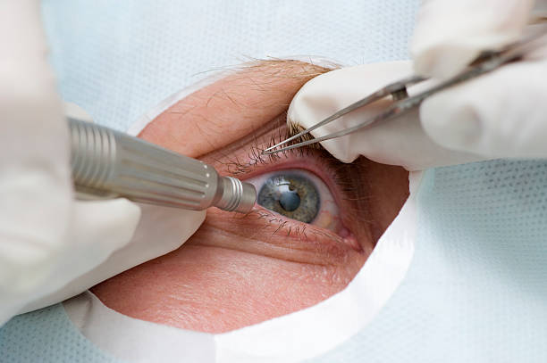 Treatment of an eye by ultrasound stock photo
