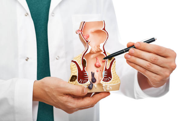 behandeling van rectale ziekten, aambei. proctoloog die pen rectumpathologieën op een anatomisch model richt - abces stockfoto's en -beelden