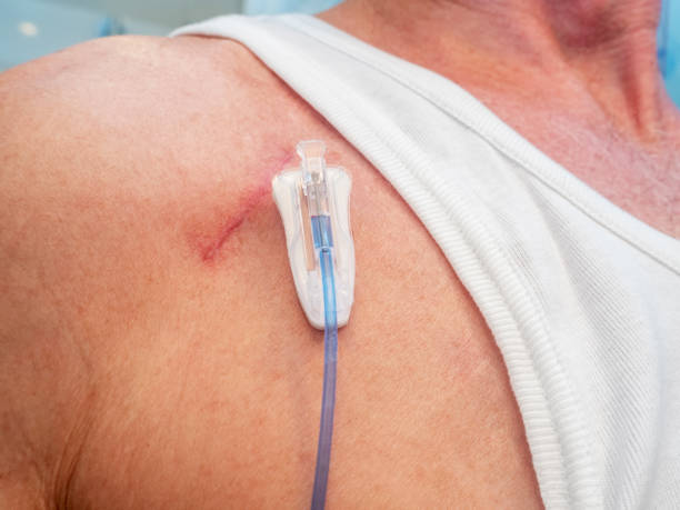 tube for intravenous fluids injections to implantable port for picture