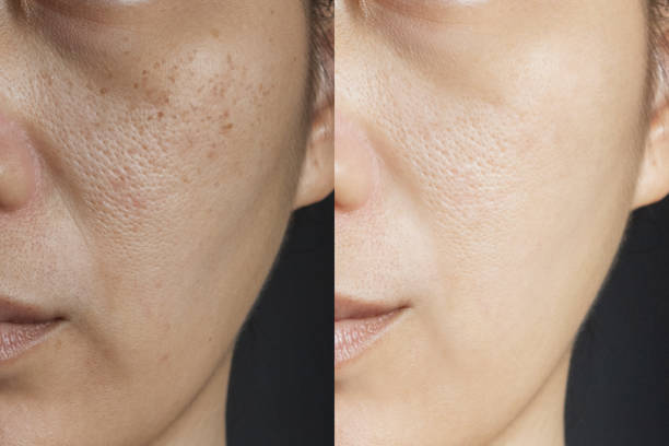 two pictures compare effect Before and After treatment. skin with problems of freckles , pore , dull skin and wrinkles before and after treatment to solve skin problem for better skin result stock photo