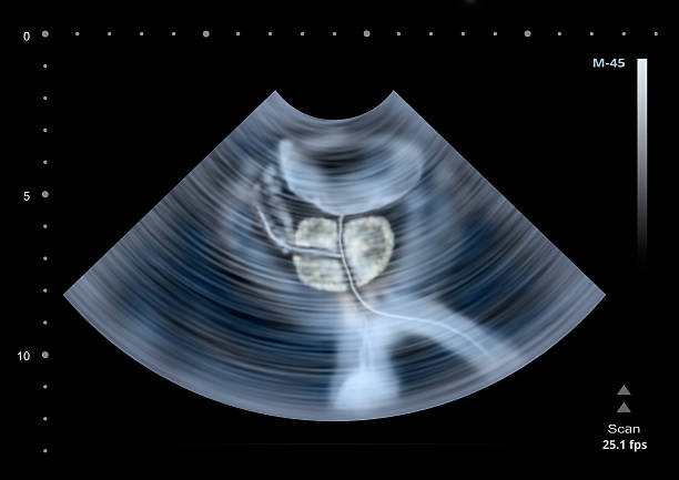 Ultrasound scan of human Prostate. stock photo