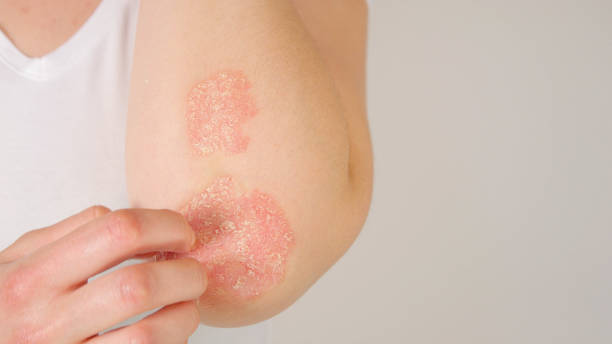 CLOSE UP: Unrecognizable female patient suffering from psoriasis skin disease stock photo