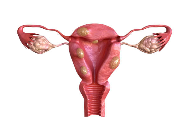 uterine fibroid are benign solid tumors formed by muscle tissue. Its size can vary greatly and some cause large abdomen increase stock photo