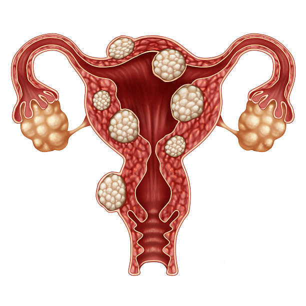 Uterine Fibroid Uterine fibroid medical concept as a human female reproduction uterus disease symbol for fertility problems and reproductive system health. ovary photos stock pictures, royalty-free photos & images