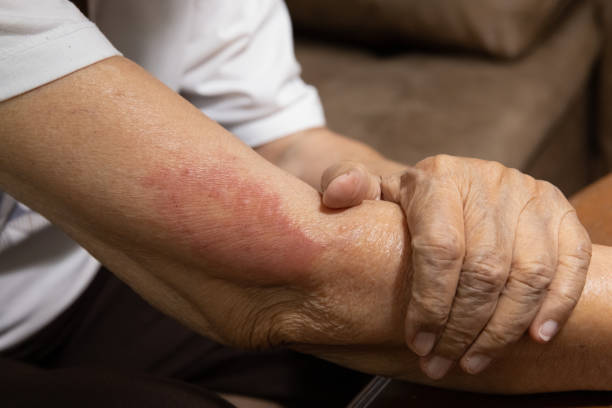 vaccine covid 19 allergies symptom in elderly after vaccination. stock photo