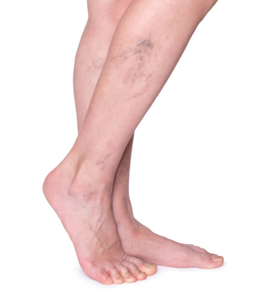 Varicose veins in the legs. Woman legs isolated on white. stock photo