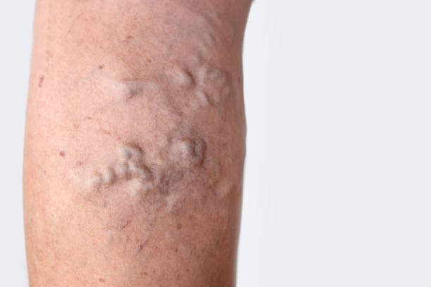 varicose veins on female leg varicose veins on female leg closeup human limb stock pictures, royalty-free photos & images