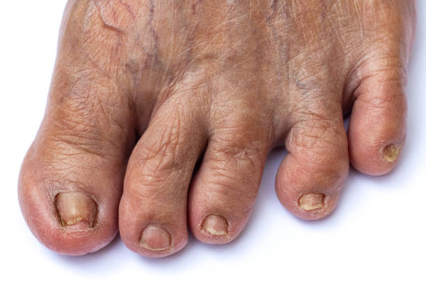 варикозные вены на левой ноге, поврежденный ногти, кривые ногти на старших ...