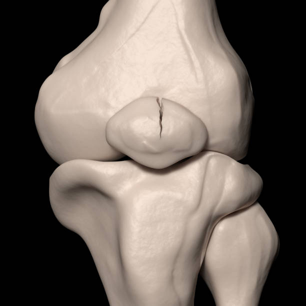 Vertical Patellar fracture stock photo