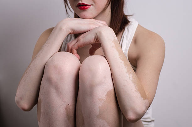 RÃ©sultat de recherche d'images pour "vitiligo photo"
