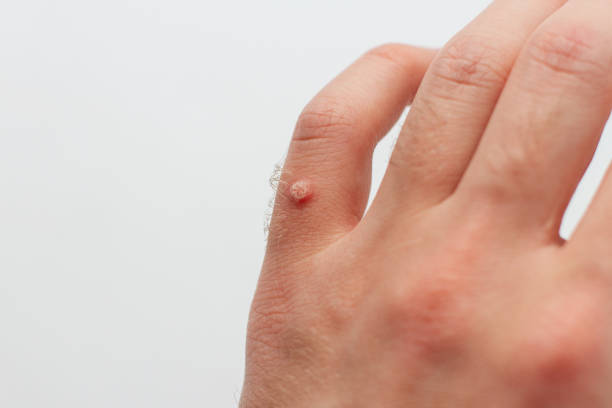 Hpv warts on hands and feet