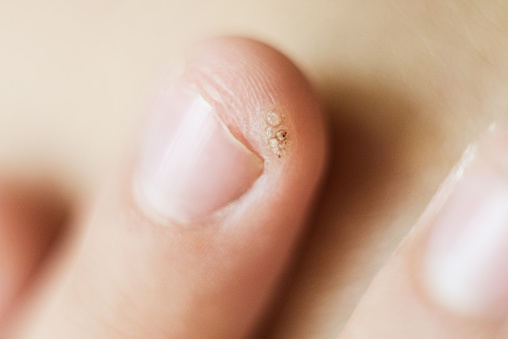papilloma on finger condilom pe testicule