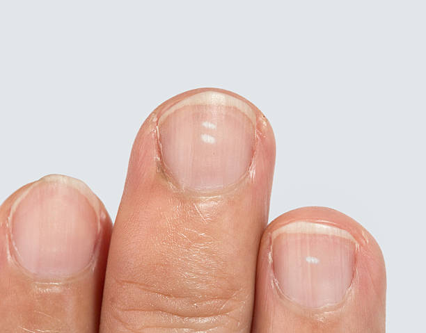 White spots on fingernails stock photo