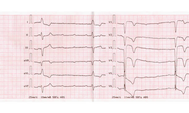 ECG with acute period of myocardial infarction of anterior wall of left ventricle, complete atrioventricular blockade stock photo