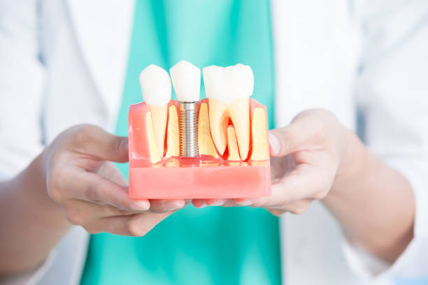 frau zahnarzt nehmen implantat zahn - zahnimplantat stock-fotos und bilder