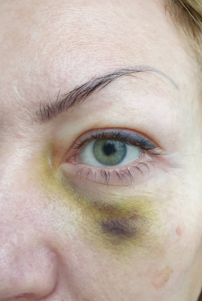woman eye injury close up woman eye injury close up black eye stock pictures, royalty-free photos & images