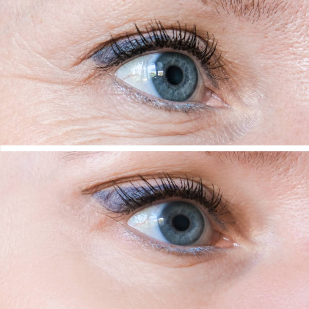 Woman face, eye wrinkles before and after treatment - the result of rejuvenating cosmetological procedures of biorevitalization, face lifting and pigment spots removal stock photo