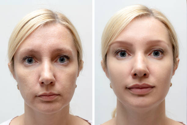 Woman face with wrinkles and age change before and after treatment - the result of rejuvenating cosmetological procedures of biorevitalization, face lifting and pigment spots removal stock photo