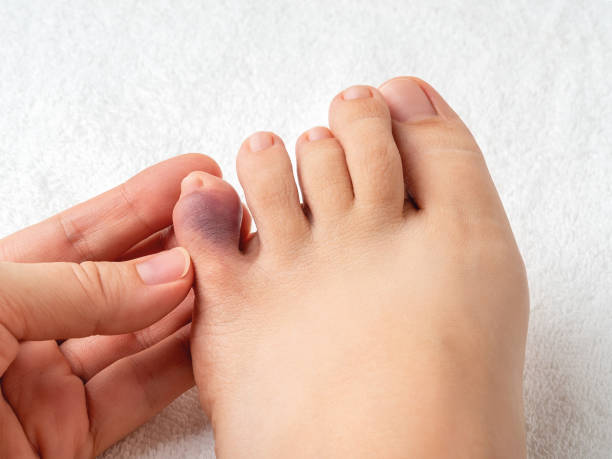 Woman hand touching little toe with purple bruise after home accident. Looking at bruised pinky toe of female person foot. Injury of foot little finger. Broken toe or phalange fracture. stock photo