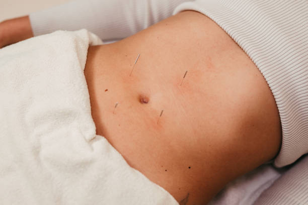 Woman having acupuncture treatment on her stomach stock photo