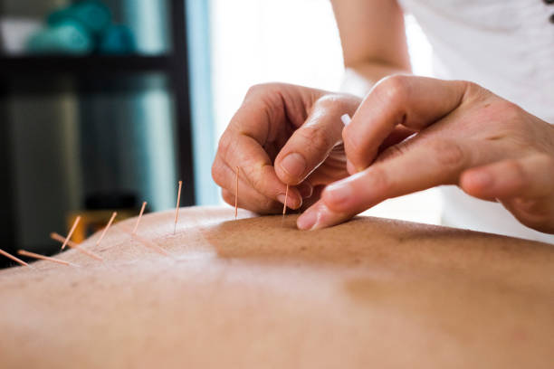 Woman having acupuncture treatment stock photo