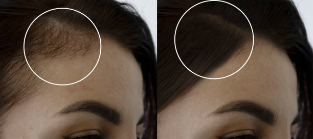 woman head baldness before and after treatment - haaruitval stockfoto's en -beelden