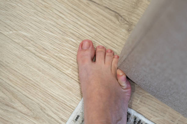 Woman hit furniture with the little toe. Incident at home. Injury of foot little finger stock photo