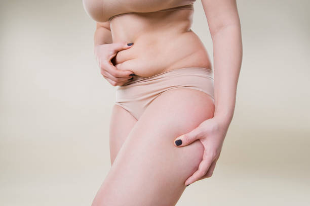 Woman holding fold of skin, cellulite on female body Woman holding fold of skin, cellulite on female body, beige background human abdomen stock pictures, royalty-free photos & images