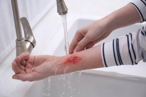 Woman holding forearm with burn under flowing water indoors, closeup Woman holding forearm with burn under flowing water indoors, closeup burning stock pictures, royalty-free photos & images