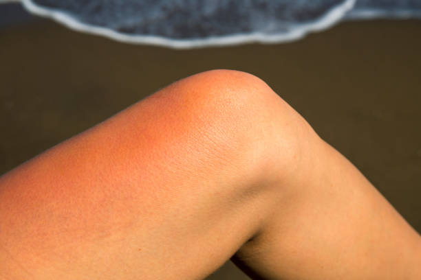 Woman leg with red sunburn skin on seaside background. Sunburned skin redness and irritation. Dangerous sun stock photo