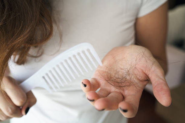 Woman losing hair on hairbrush in hand stock photo