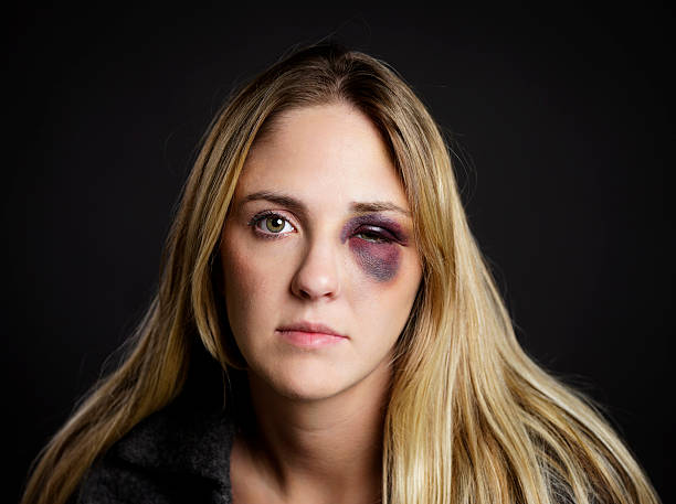 Woman with a Black Eye A close-up of a pretty young blond woman with a black eye. black eye stock pictures, royalty-free photos & images