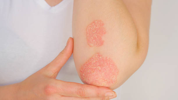 CLOSE UP Woman with big red scaly rash suffering from elbow psoriatic arthritis stock photo