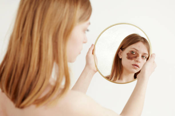 Woman with birthmark on face looking at mirror stock photo