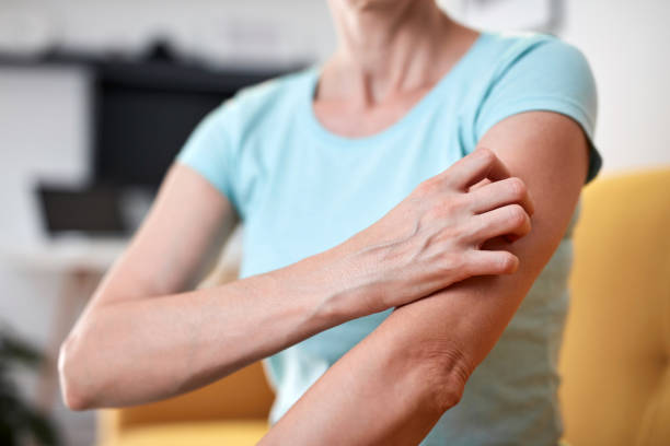 Woman with itchy, tingling arms scratching skin. stock photo