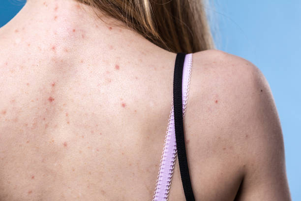 Back Acne Stock Photos, Pictures & Royalty-Free Images - iStock